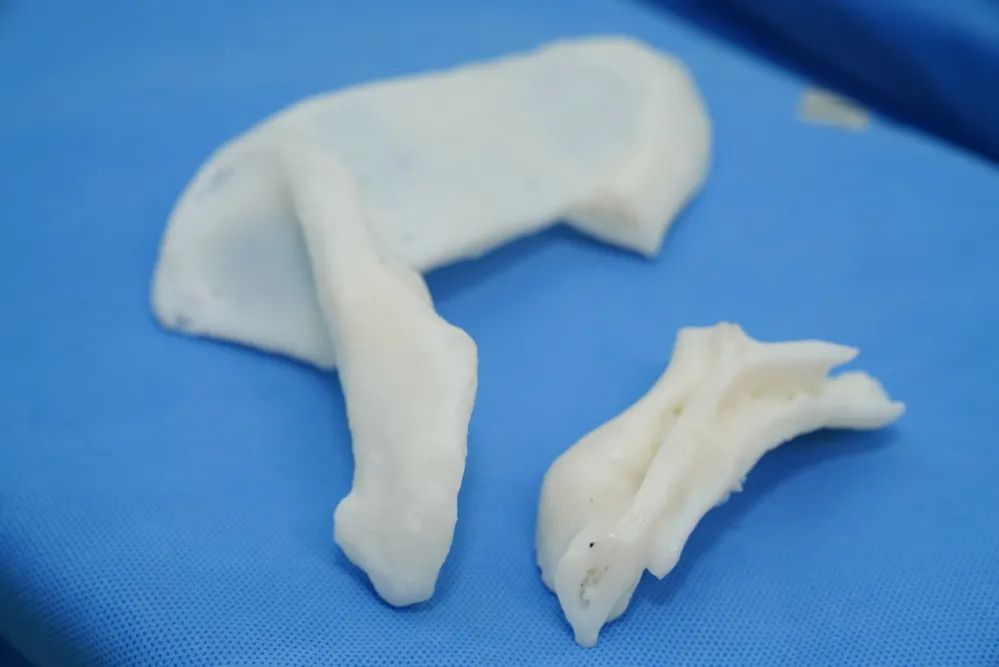 3D打印反肩置換，解決患者疑難復(fù)雜肩關(guān)節(jié)陳舊毀損傷難題
